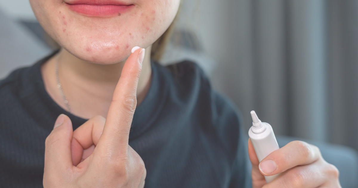 Acne Side effects, Medicines, and Signs (1)